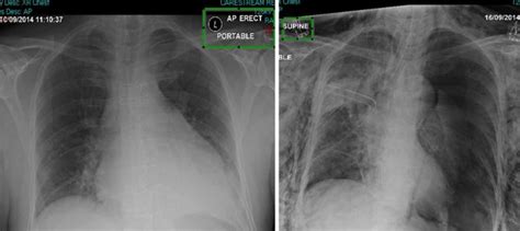 A Guide To Mobile Chest X Rays For Thoracic And Cardiac Care A Guide To Mobile Chest X Rays For Thoracic And Cardiac Care