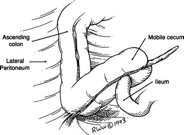 5 Ways Mobile Cecum Affects Health